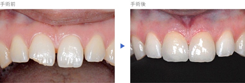 前歯の症例