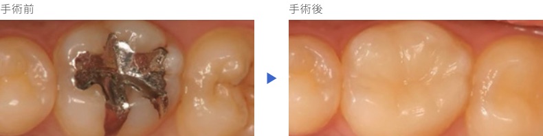 奥歯の症例(詰め物)